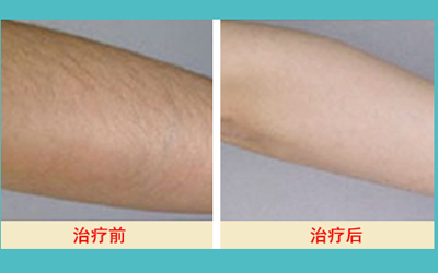 激光脫毛的價格解析，多少錢才能擁有絲滑肌膚？，激光脫毛價格詳解，多少錢能擁有絲滑肌膚？